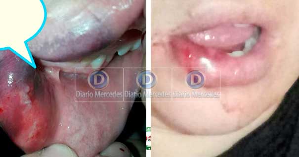 Le Rompieron La Boca Al Intentar Ayudar A Otra Mujer Que Era Golpeada Por Su Pareja.-